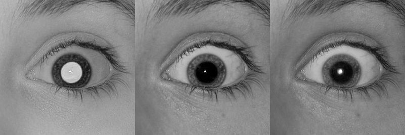 Channels of an affected by Red-Eye